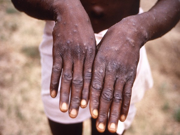New clinical symptoms in confirmed monkeypox cases identified